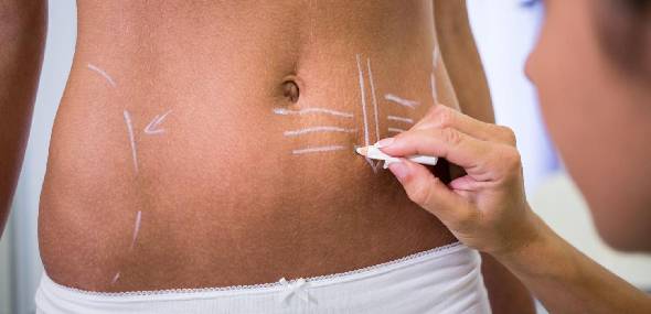 Corpo sarado: Dr. Rafael de Fina explica a lipo HD
