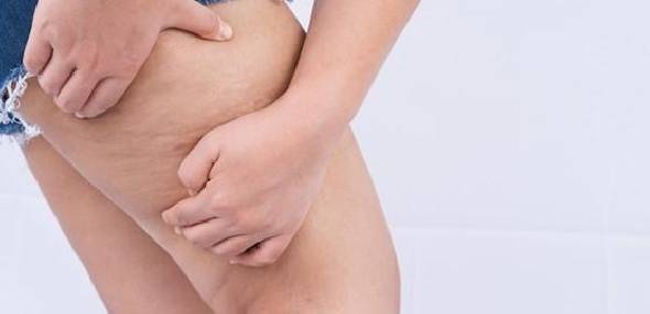 Lipedema: uma doença pouco conhecida, mas que atinge milhares de mulheres