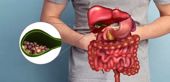 Pedra na vesícula: cirurgia para retirada do órgão está mais simples e eficaz
