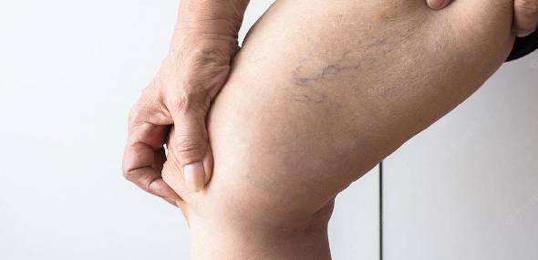 Tratamento de varizes sem cortes, tecnologia substitui cirurgia convencional